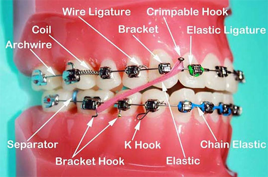 parts-of-braces-2