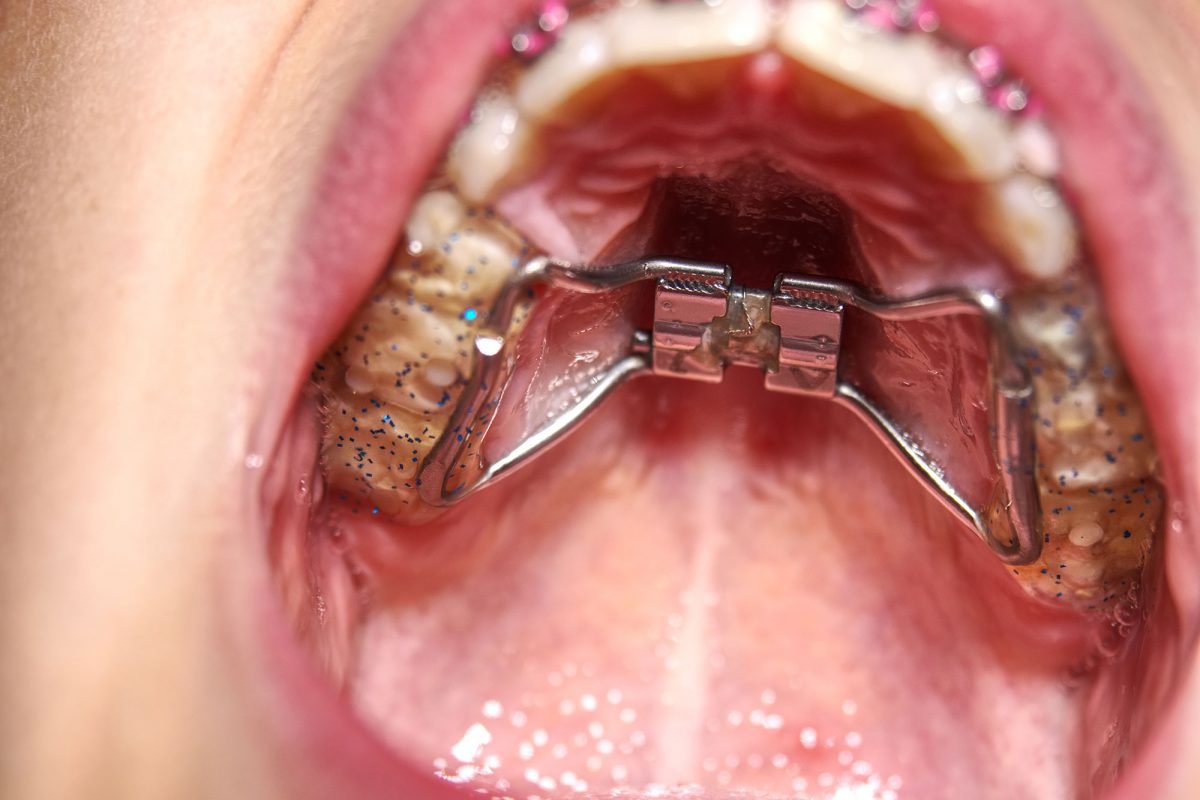 Palatal Expanders FAQ - Everything You Need to Know