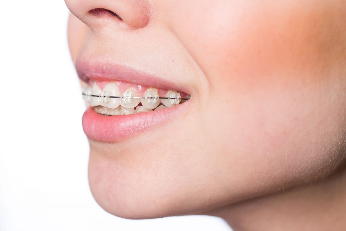 What Is An Overbite Bordentown Braces